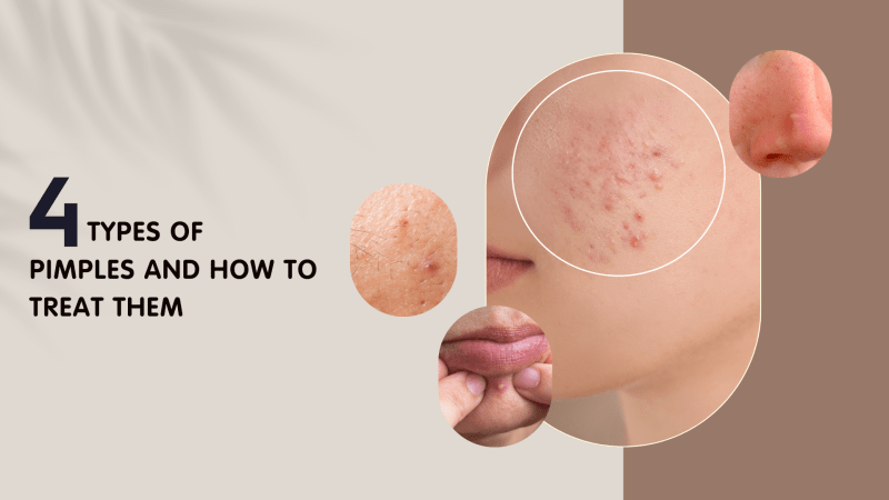 4 types of pimples and How to Treat Them