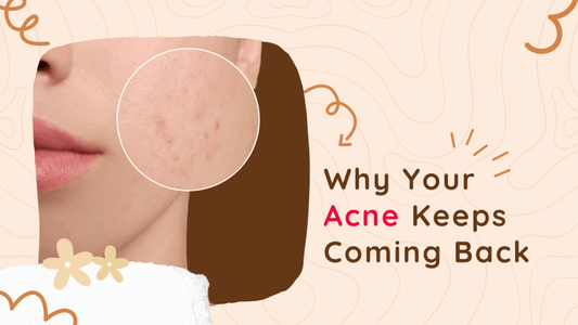 Why Your Acne Keeps Coming Back - Tikitoro